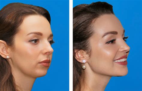 Chin Surgery Genioplasty