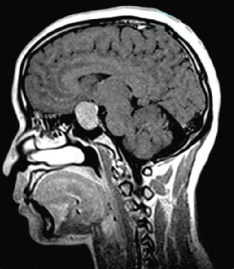 MRI finding of pituitary tumors. | Download Scientific Diagram