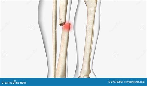 fracture  referred    broken bone   acute injury