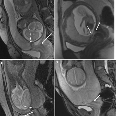 Umbilical Cord Insertion A Normal Central Cord Insertion Sagittal T2w Download Scientific