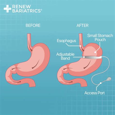 Lap Band Removal Surgery Gastric Band Removal In Mexico