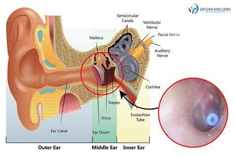 Myringotomy And Grommet Tube Insertion Understanding The Procedure And