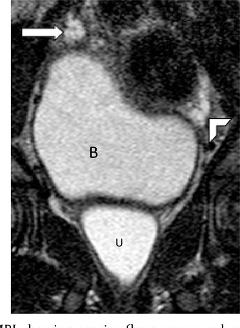 Figure 1 From Role Of Magnetic Resonance Imaging In Assigning Sex In An Ambiguous Genitalia