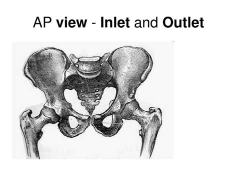 PPT - Pelvis fracture PowerPoint Presentation - ID:737949