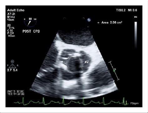 Two Dimensional Transesophageal Echocardiography Midesophageal Aortic