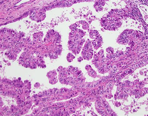 Pathology Outlines Papillary Adenocarcinoma