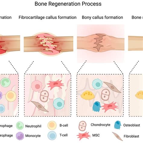 The Figure Of Bone Fracture Healing Process The Several Phases Of