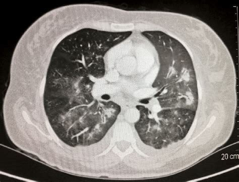 Chest Ct Scan Axial Lung Window Some Areas Of Consolidation With