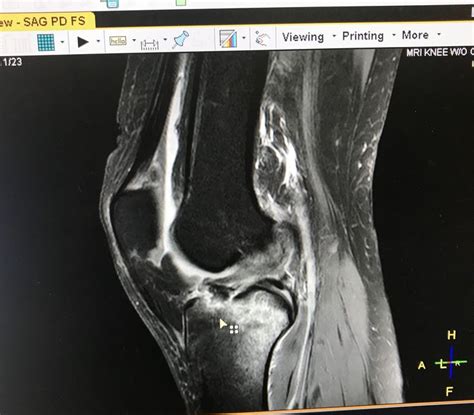 Acl Tibia Avulsion Fracture Mri Avulsion Fracture Fracture Acl