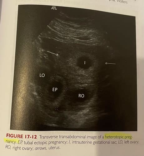 Ch Sonographic Assessment Of The Ectopic Pregnancy Flashcards