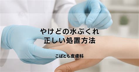 やけどの水ぶくれは潰すべき？正しい処置と早くきれいに治すためのケア方法｜こばとも皮膚科｜栄駅（名古屋市栄区）徒歩2分