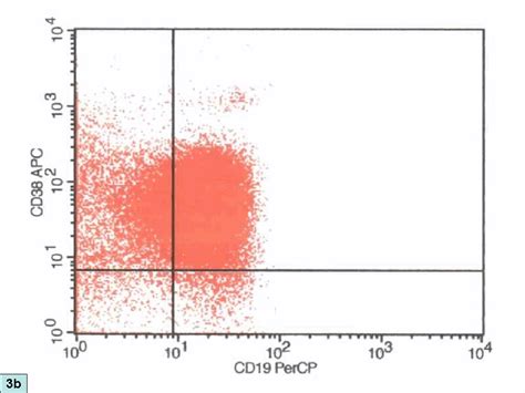 Acute Leukemia Flow Cytometry In Acute Leukemia