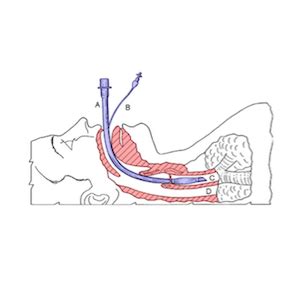 Tracheal intubation in critical care - expert guidelines