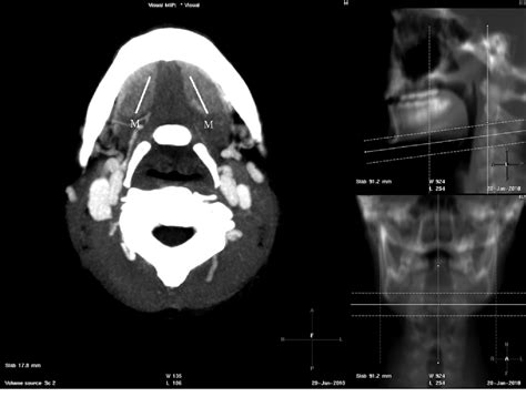 Figure 3 From Ct And Mr Findings Of Bilateral Submandibular Gland