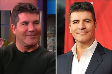 Simon Cowell Before and After Plastic Surgery: Facelift, Botox