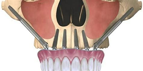 Zygomatic Implants Proclinix Dental Implant Centre