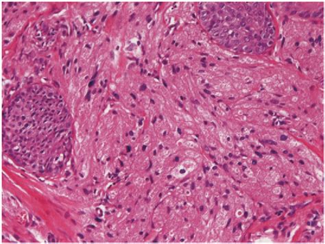 cmv esophagitis | Semantic Scholar