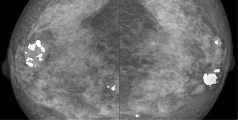 Prognosis Fibroadenoma Mammae Fam Alomedika