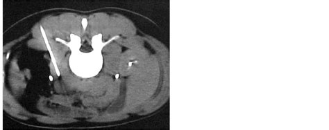 Contrast Enhanced Ct Guided Core Biopsy Of Retroperitoneal Masses