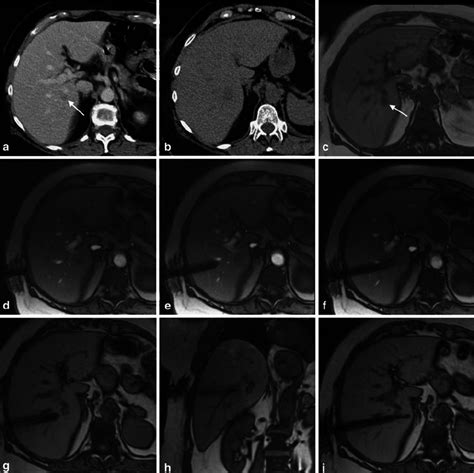 A I Mr Guided Biopsy With A Lateral Approach In A Female Patient With Download Scientific