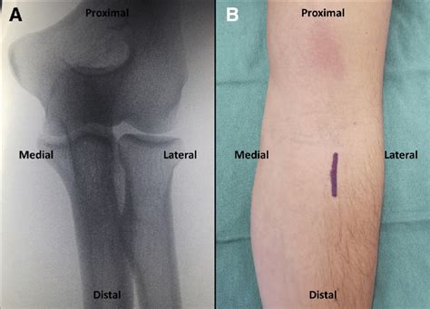 (A) Intraoperative fluoroscopy of right elbow demonstrating location of ...