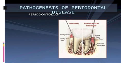 Ppt Pathogenesis Of Periodontal Disease Pdfslidenet