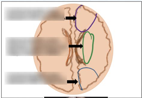 Lecture Cerebrovascular Diseases Diagram Quizlet