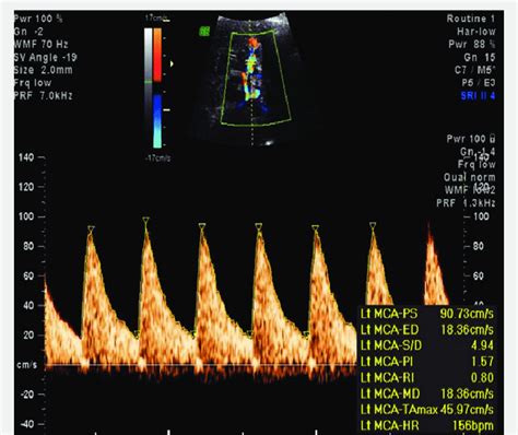 Elevated Peak Systolic Velocity Seen In Middle Cerebral Artery Doppler Download Scientific