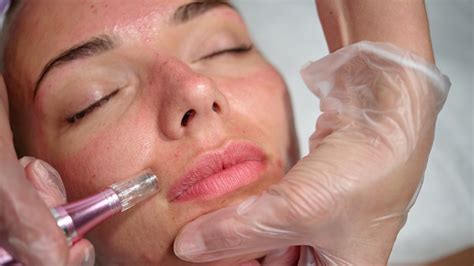 All The Benefits You Can Expect From Microneedling