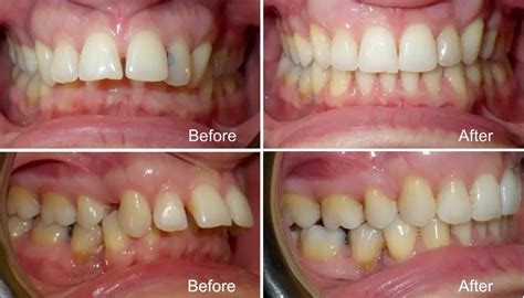 What is Overjet: Symptoms, Diagnosis and Orthodontic Treatment