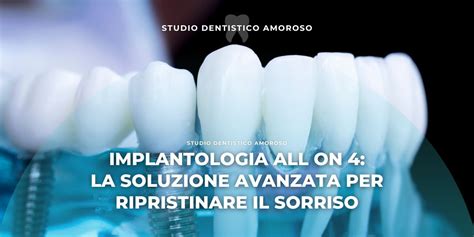 Implantologia All On Per Ripristinare Il Sorriso