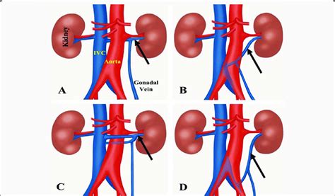 Schematic Illustration Of Four Different Types Of Retro Aortic Left