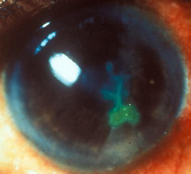 Cornea Diseases | Cornea ConsultantsTX