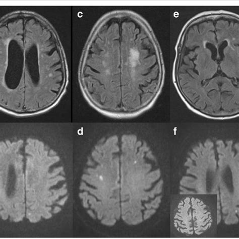 Brain Magnetic Resonance Imaging Of Three Patients During Septic Shock Download Scientific