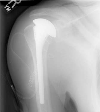 Shoulder and Elbow Surgery: Shoulder hemi-arthroplasty for humeral head ...