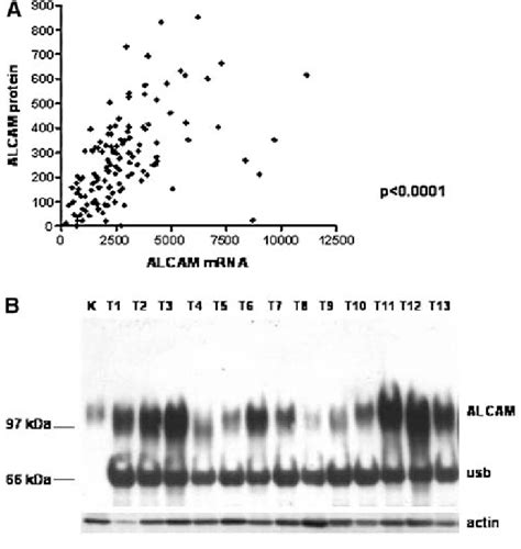 Alcam Mrna And Protein Expression In Tissue Extracts From Mammary