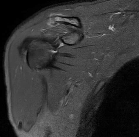 Acromioclavicular Junction Injury Mri Sumers Radiology Blog