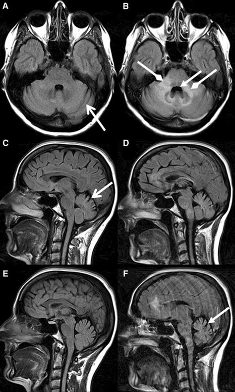 Axial Fluid Attenuated Inversion Recovery Flair Images A D And Download Scientific