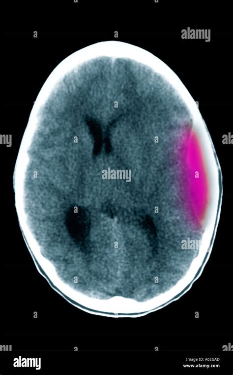 Epidural Hematoma