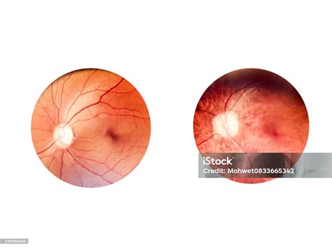 Patient Elderly With Retina Of Diabeteshuman Eye Anatomy Taking Images