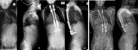 Instrumentation Strategies For Early Onset Scoliosis Journal Of The