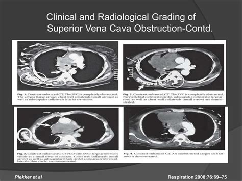 Superior Vena Cava Syndrome Ppt