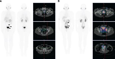 Frontiers 99mTc Tc HYNIC ALUG SPECT CT In The Initial Staging Of 227