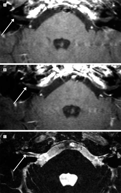 Acute Vestibular Neuritis Visualized By 3 T Magnetic Resonance Imaging With High Dose Gadolinium