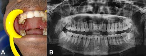 Scielo Brasil Acantholytic Oral Squamous Cell Carcinoma With Clear