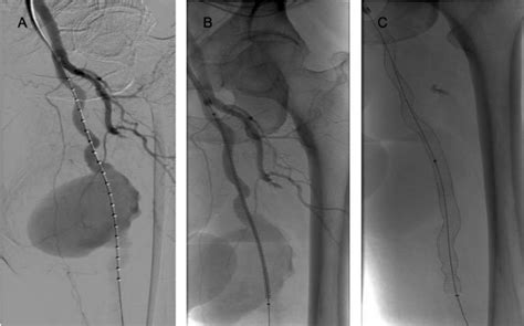 Angiography Obtained During Implantation Of The Viabahn Endovascular