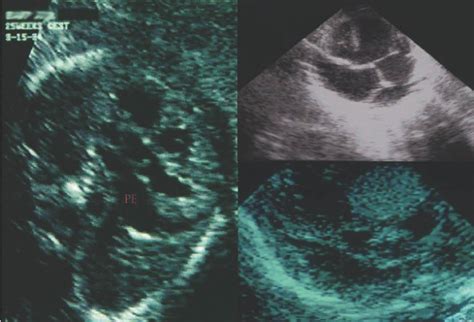 La Importancia De La Ecocardiografía Fetal En La Detección Y El Manejo