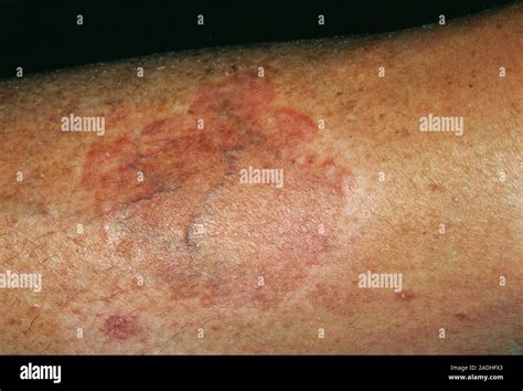 Skin Lesions Close Up Of The Leg Of A Year Old Female Patient