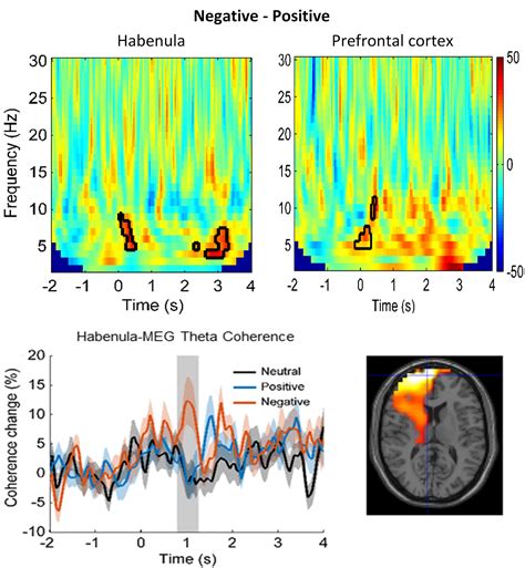 Increased Theta Alpha Synchrony In The Habenula Prefrontal Network With