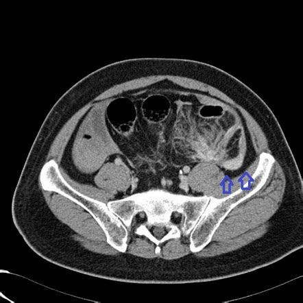 Bowel And Mesenteric Trauma Radiology Reference Article Radiopaedia Org